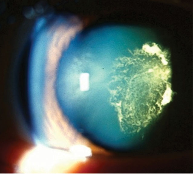 RevOphth's tweet image. Anti-VEGF Injection May Increase Cataract Risk

A recent study found that injection-receiving eyes are at greater risk of later requiring surgery, particularly in older patients. Read more in this month's News column: reviewofophthalmology.com/article/lifest…

#ophthalmology #cataract