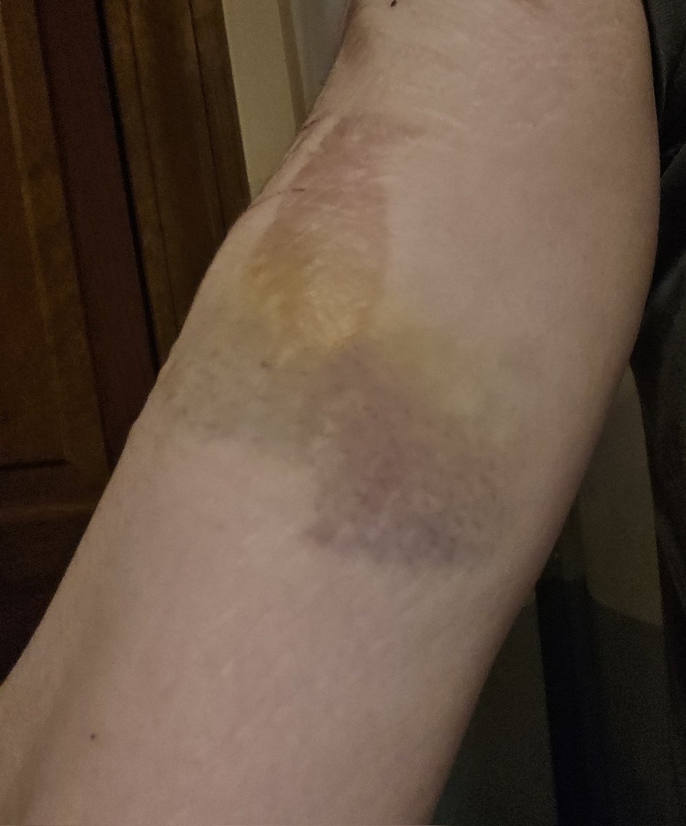 ppoopp129's tweet photo. Bruises from a few days ago,, (reposting cause i forgot to censor the first!) https://t.co/XwAdEChJ0z
