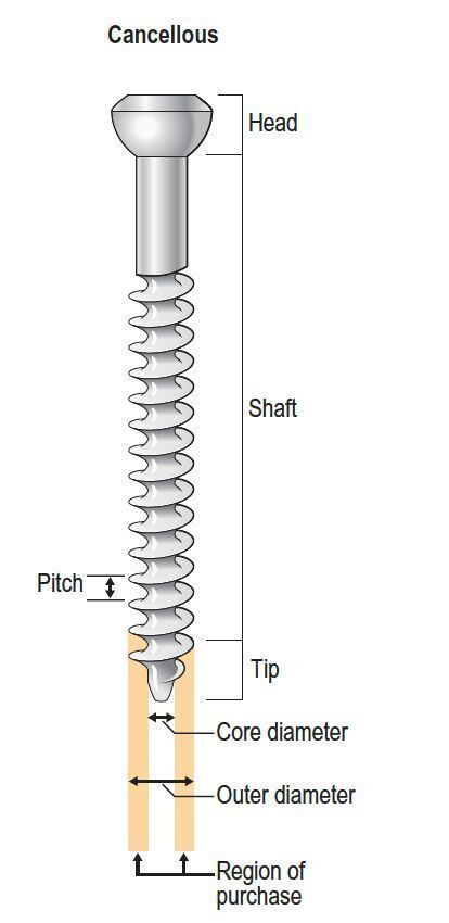 Cortical vs Cancellous screws.