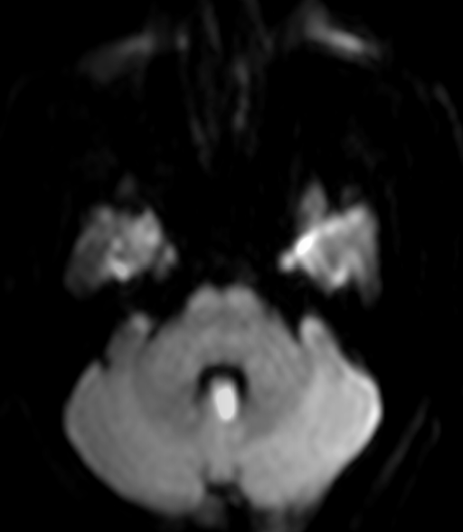 whitfieldlewis6's tweet image. This is an axial plane of an MRI Brain showing diffusion restriction of a cerebellar structure in the posterior fossa. 

What is this structure? 
An isolated lesion here causes what deficits? 
What NIHSS will this person have? 
What's the blood supply?

Drop your thoughts below