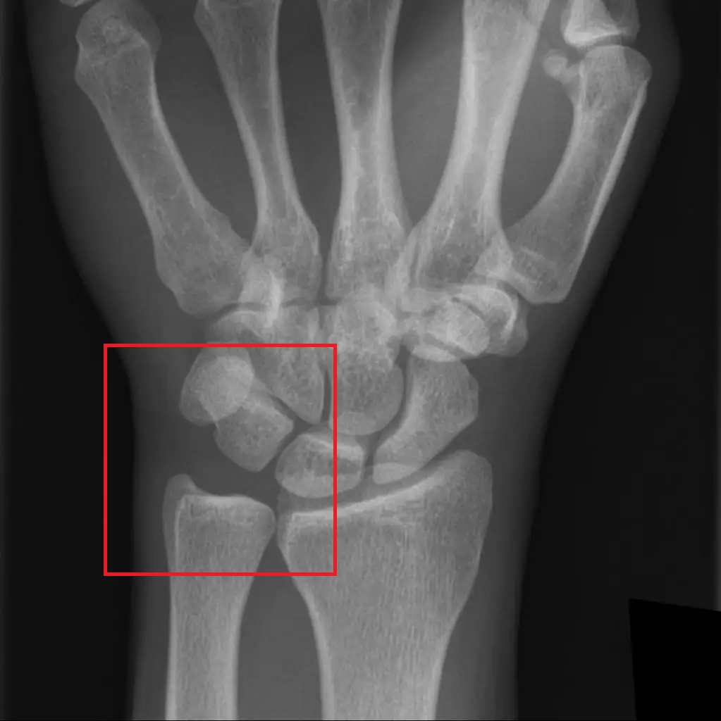 MedEd_Cases's tweet image. The ulnocarpal joint is formed by the distal ulna, the triangular fibrocartilage complex, and the ulnar-sided carpal bones, primarily the lunate and triquetrum, creating a key articulation on the ulnar side of the wrist. It functions to transmit load from the forearm to the