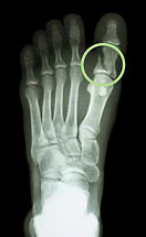 DrJesseMorse's tweet image. George Springer

Left big toe fracture after fouled ball off it

Differential possibilities: 

1. Non-displaced distal phalanx fracture 

Return to Play (RTP): 2-4 weeks 

2. Non-displaced proximal phalanx fracture 

Return to Play (RTP): 4-6 weeks 

3. Displaced fracture