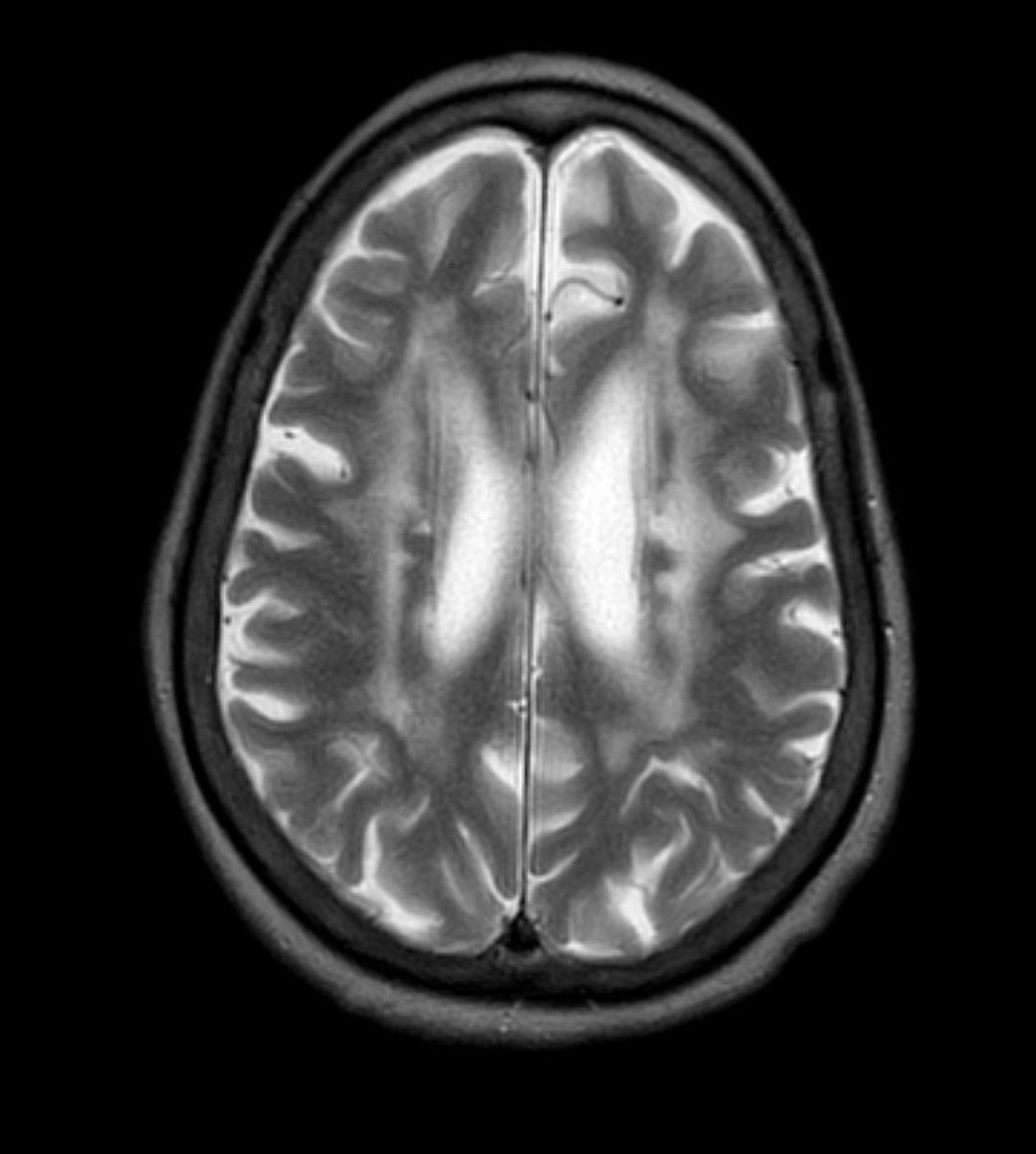 nirmalregency's tweet image. Is the term ischemic demyelination well accepted in #neuroradiology? Just wondering.