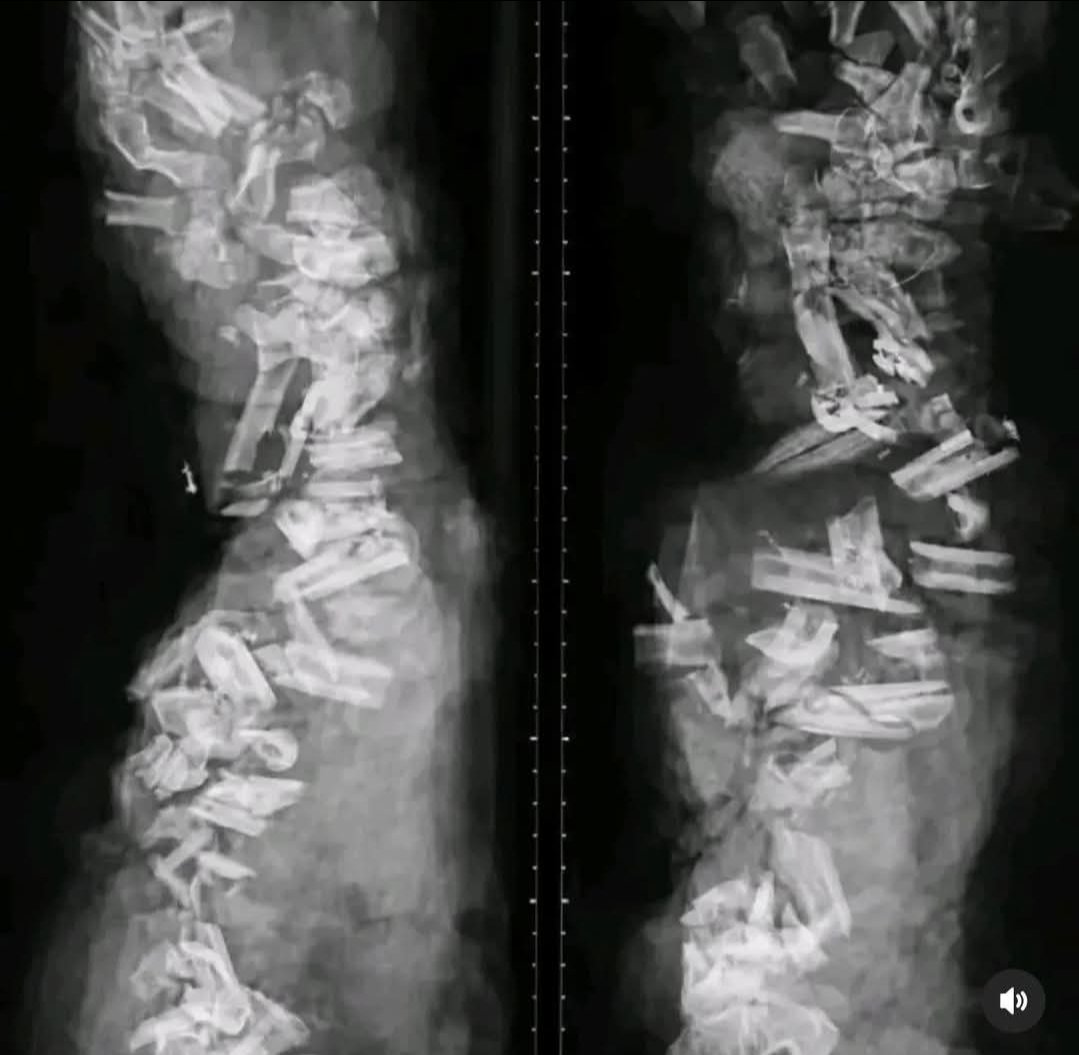 Dr.Hakan Akelma 🩺 tweet media