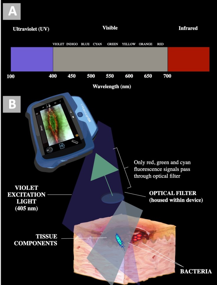 DGArmstrong's tweet image. Current and Future Directions in Fluorescence Imaging Guided Debridement #ActAgainstAmputation #Diagnostics #Theragnostics @ResearchatUSC @USC_vascular @keckschool_usc diabeticfootonline.com/2024/07/07/cur…