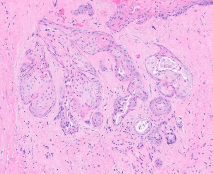 Janiranavarro's tweet photo. 67 yo male
History of supraglottic/glottic SCC s/p radiation
Now presenting with glottic stenosis

Biopsy shows sialometaplasia: a benign reactive process that is frequently misdiagnosed as recurrent SCC

- Commonly occurs after radiation or chemoradiation for head and neck SCC
- Can appear on ANY mucosal site
- Preserves lobular architecture
- Smooth borders with minimal atypia
- Myoepithelial layer sometimes present (pic 4)

Dr. Cipriani #USCAP2026 #pathology #PathX #PathTwitter