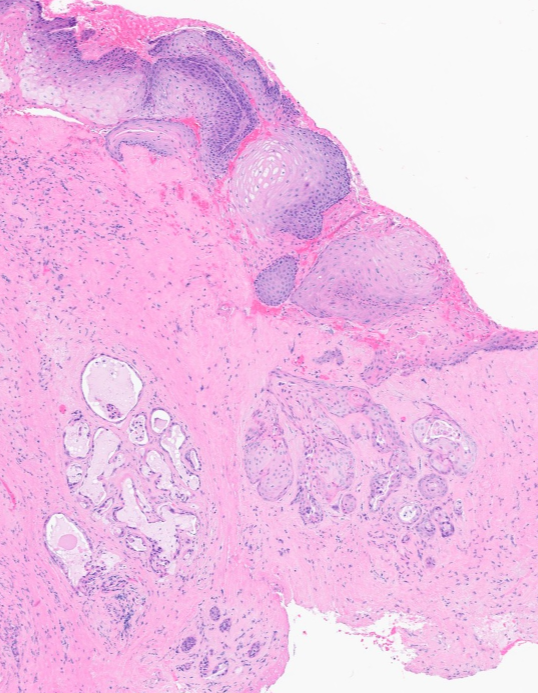 Janiranavarro's tweet photo. 67 yo male
History of supraglottic/glottic SCC s/p radiation
Now presenting with glottic stenosis

Biopsy shows sialometaplasia: a benign reactive process that is frequently misdiagnosed as recurrent SCC

- Commonly occurs after radiation or chemoradiation for head and neck SCC
- Can appear on ANY mucosal site
- Preserves lobular architecture
- Smooth borders with minimal atypia
- Myoepithelial layer sometimes present (pic 4)

Dr. Cipriani #USCAP2026 #pathology #PathX #PathTwitter