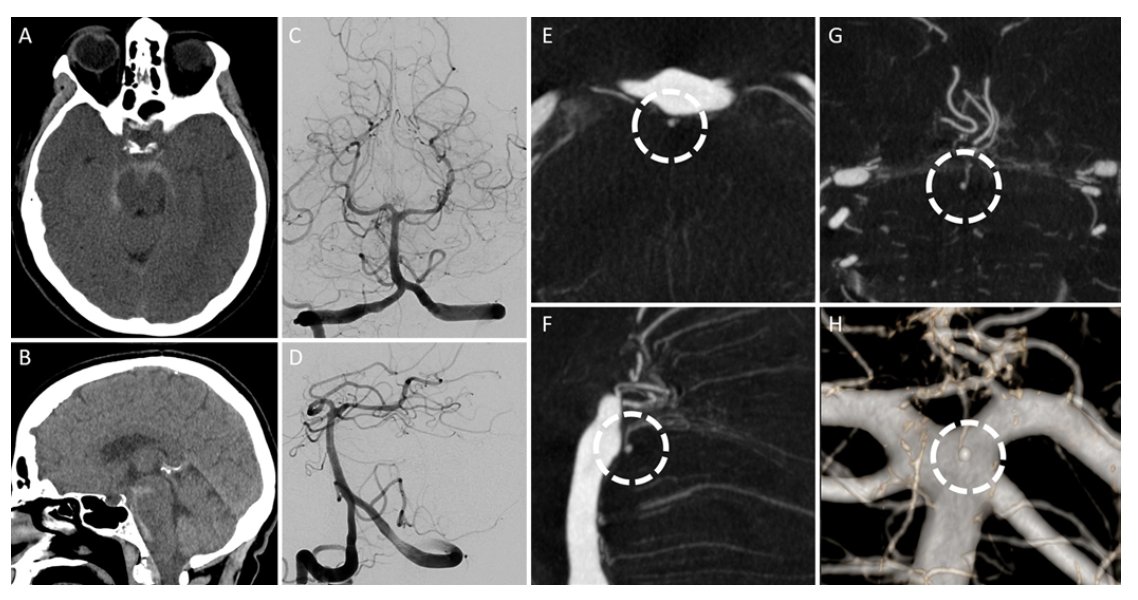 TheJNS's tweet image. #OnlineFirst: Basilar artery perforator rupture as the cause of perimesencephalic subarachnoid hemorrhage. 

thejns.org/view/journals/…