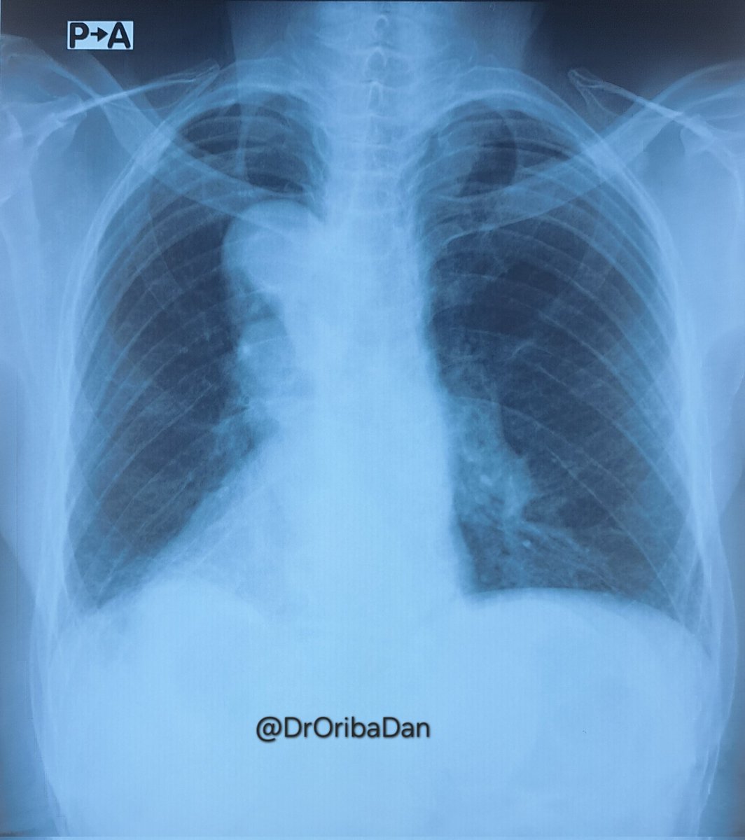 DrOribaDan's tweet image. Case 🩺
86y/F
😷 Bothersome non-productive cough, 🥴 Dysphagia, 🗣️ Hoarseness of voice
🩻 chest X-ray done
📈 BP: 157/98 mmHg ❓ What is your diagnosis?
💡 Think beyond the lung as well. ✍️🇺🇬📚
@MakCHS_SOM @lacor_hospital @DilipMysore @drkeithsiau @UgandaPhysician @rkalyes1