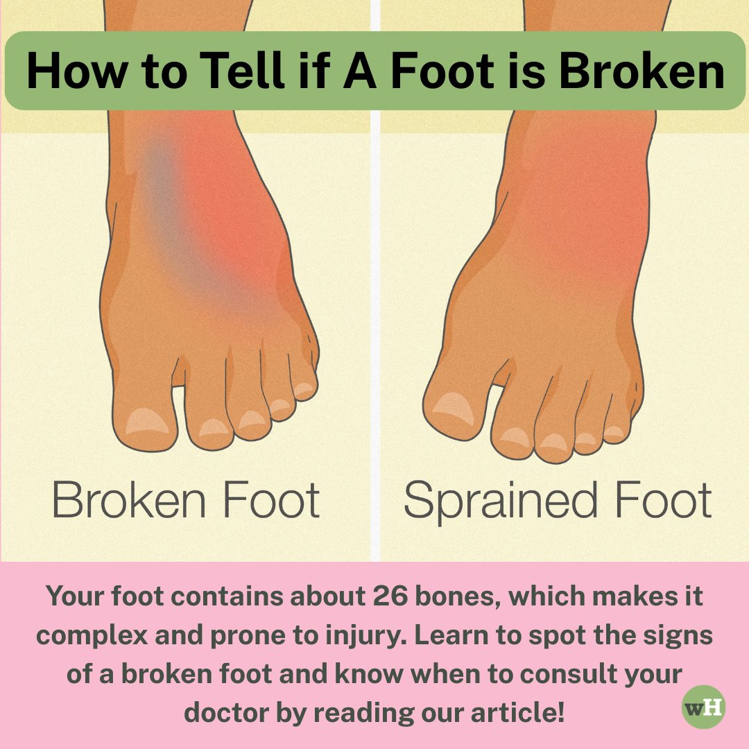 wikiHow's tweet image. Think your foot injury might be more than just a sprain? 🦶💥 Check the signs in our guide and always consult a healthcare professional for a proper diagnosis. wikihow.com/Tell-if-Your-F…🩺✨

#FootHealth #FirstAid #wikiHow #BrokenFoot