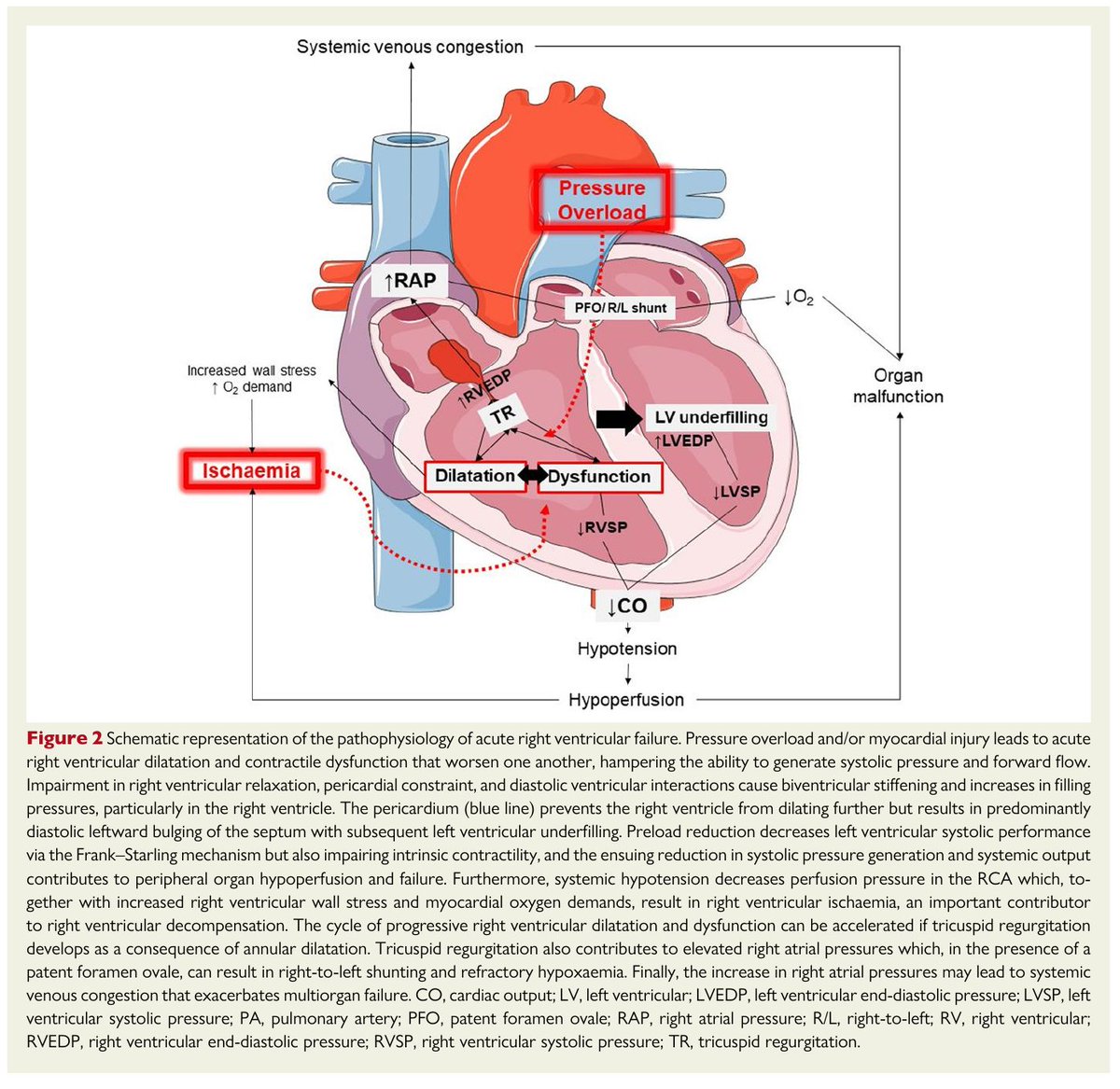 MHcsba's tweet image. ESC 2025: Falla ventricular derecha
 doi.org/10.1093/eurhea…
#MedEd #MedTwitter #MedX
medicina-interna.org
