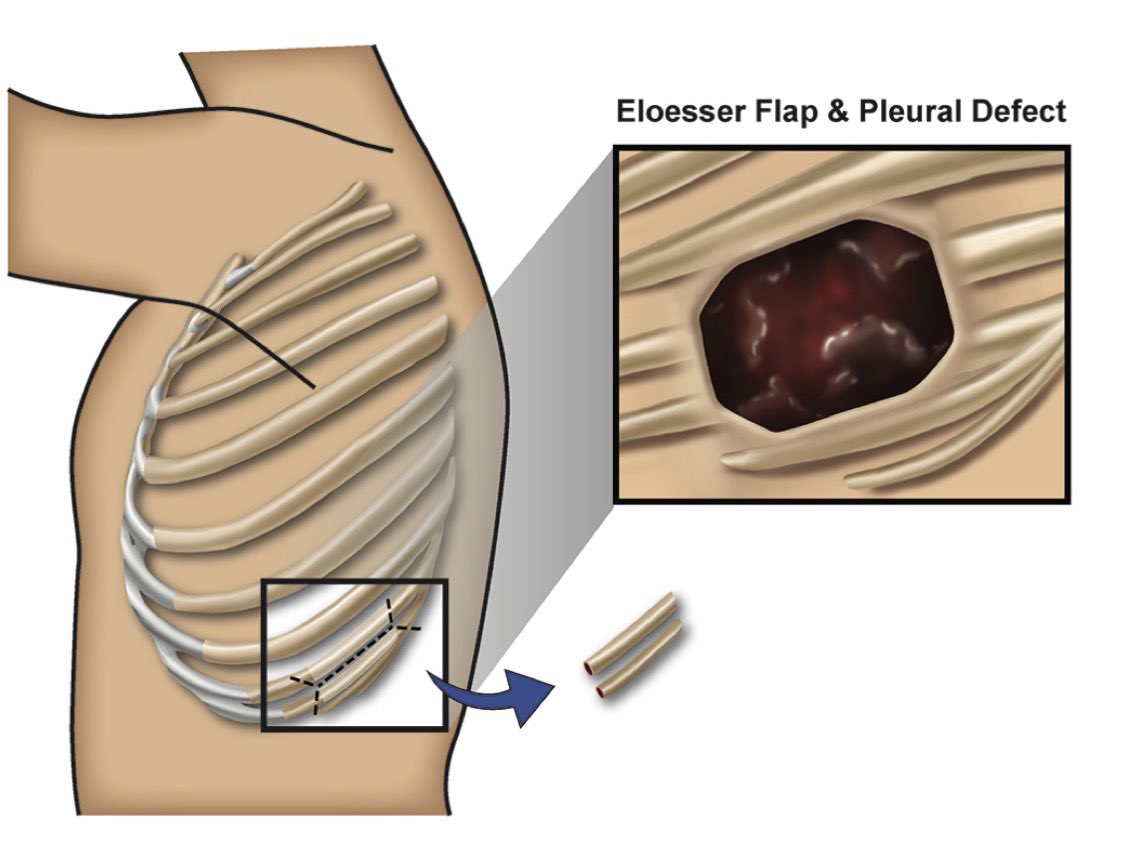 ibflormed's tweet photo. Thrilled for the opportunity to describe our center’s approach to the Eloesser thoracoplasty in the contemporary era: an option for your most intransigent thoracic consults! @annals_short @CooperSurgery 

https://t.co/zLg5CfEO0E https://t.co/mQzB1zHH8u