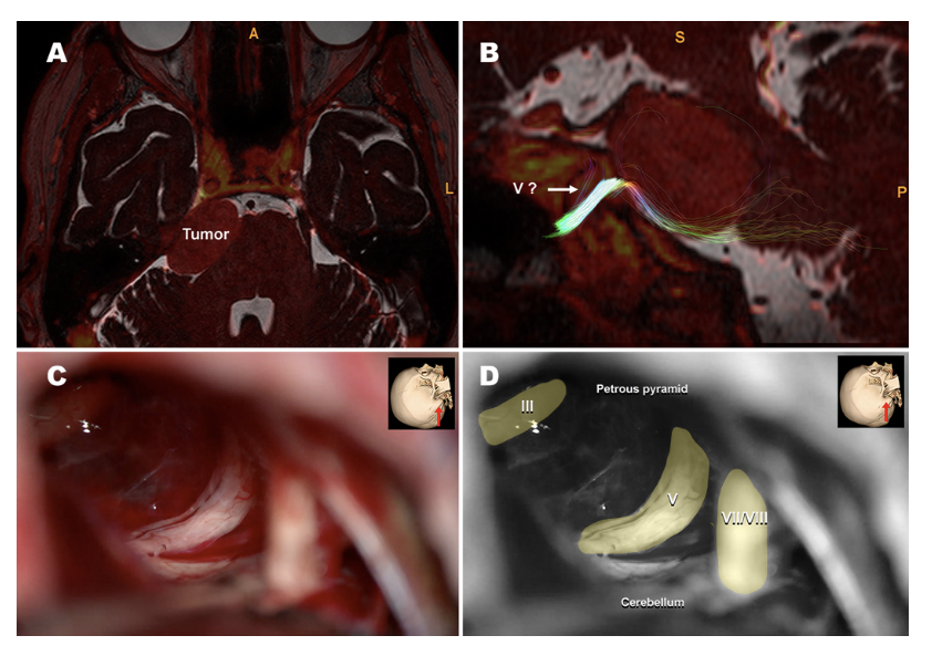 TheJNS's tweet image. #OnlineFirst: High-resolution T2-weighted MRI versus tractography to predict cranial nerve anatomy in skull base tumors: a retrospective 132-case series.

thejns.org/view/journals/…