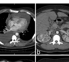 DiagnosticCyto's tweet photo. Read New Timely Review @DiagnosticCyto. When Lymphoma Reaches the Heart: A Narrative Review of Cardiac Tamponade Presentations.
https://t.co/HajwzVzoaf
@aakasharmand @DianaEstherossi @PoonamVohra3 @AzizaNassar2 @PapSociety @IACytology https://t.co/L6mb4HSJm6