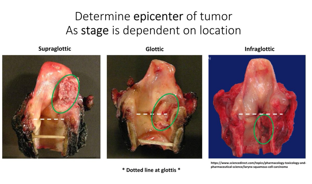 DrCycloPath's tweet photo. Laryngeal anatomy matters because stage depends on tumor location.

False cord = supraglottic compartment
True cord = glottic compartment https://t.co/pH6Ek6pbVt