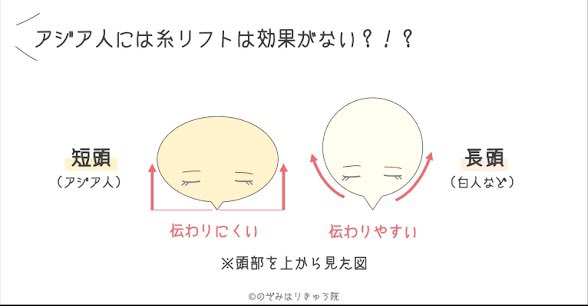 omonaga_life's tweet photo. 最近激安糸リフトが流行ってるから糸リフトオタクとしてアドバイスしたい

糸リフトは②の入れ方を激推ししてる‼️

①の入れ方が主流だけど、
日本人は頬骨張ってる人が多いから
②で入れると頬骨に邪魔されずに引き上がる&amp;長持ちしてほんとにおすすめ

私は①だとかえって頬骨でかく見えてしまった… https://t.co/4iQDM9GuoB