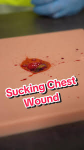 KoassPintar's tweet photo. 🚑 KASUS IGD LAGI

Remaja laki-laki, korban tawuran. tusukan di dada kanan.

Dari lukanya: darah berbuih, udara keluar-masuk setiap napas.

sucking chest wound. gw tutup rapat pakai plester di 4 sisi.

15 menit kemudian — henti jantung. 🧵 https://t.co/gCTlt0hdeW