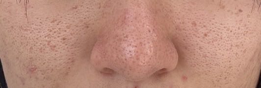 waw_dm's tweet image. ほんと汚くてごめんすぎるけどまじでこの肌どうしたらいいの、߹𖥦߹
集合体恐怖症の人いたらごめんね
こんな肌だからメイクしてもファンデが馴染まなくてクレーターが目立ってボコボコする😭 鼻の皮膚あついのもコンプ
何したら治るん？