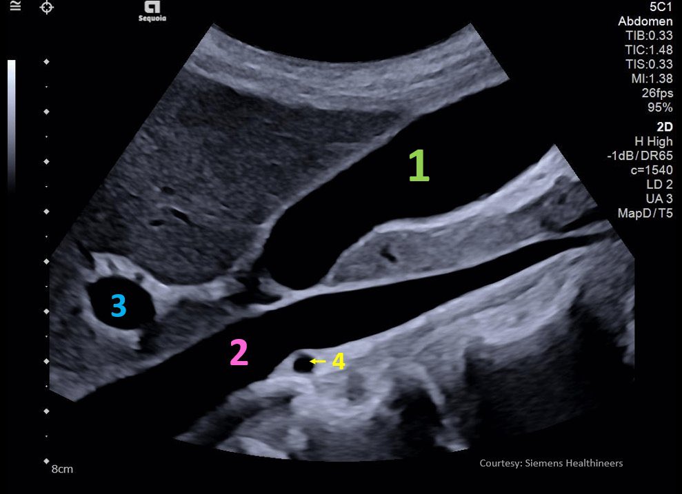 NephroP's tweet image. #POCUS #anatomy quiz:
Identify 1️⃣2️⃣3️⃣4️⃣ on this upper abdomen scan.
#FOAMed #Nephpearls