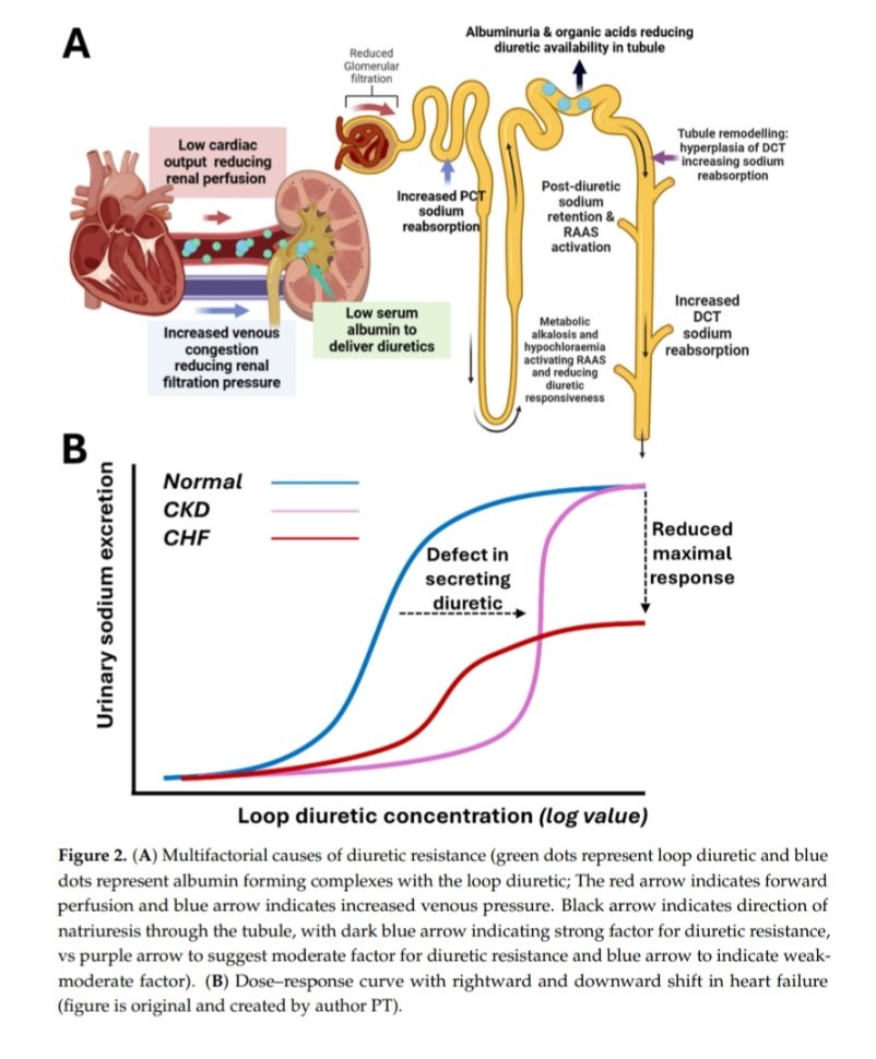 SayedSRahman1's tweet image. A Pragmatic Approach to Acute Cardiorenal Syndrome: 
Diagnostic Strategies and Targeted Therapies to Overcome Diuretic Resistance

#VeXUS
 mdpi.com/2077-0383/14/9…