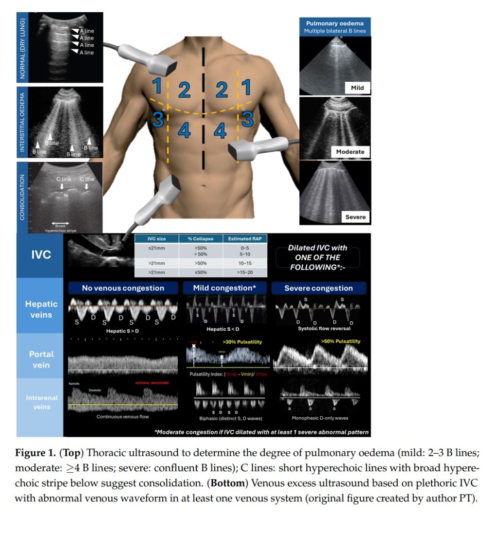 SayedSRahman1's tweet image. A Pragmatic Approach to Acute Cardiorenal Syndrome: 
Diagnostic Strategies and Targeted Therapies to Overcome Diuretic Resistance

#VeXUS
 mdpi.com/2077-0383/14/9…