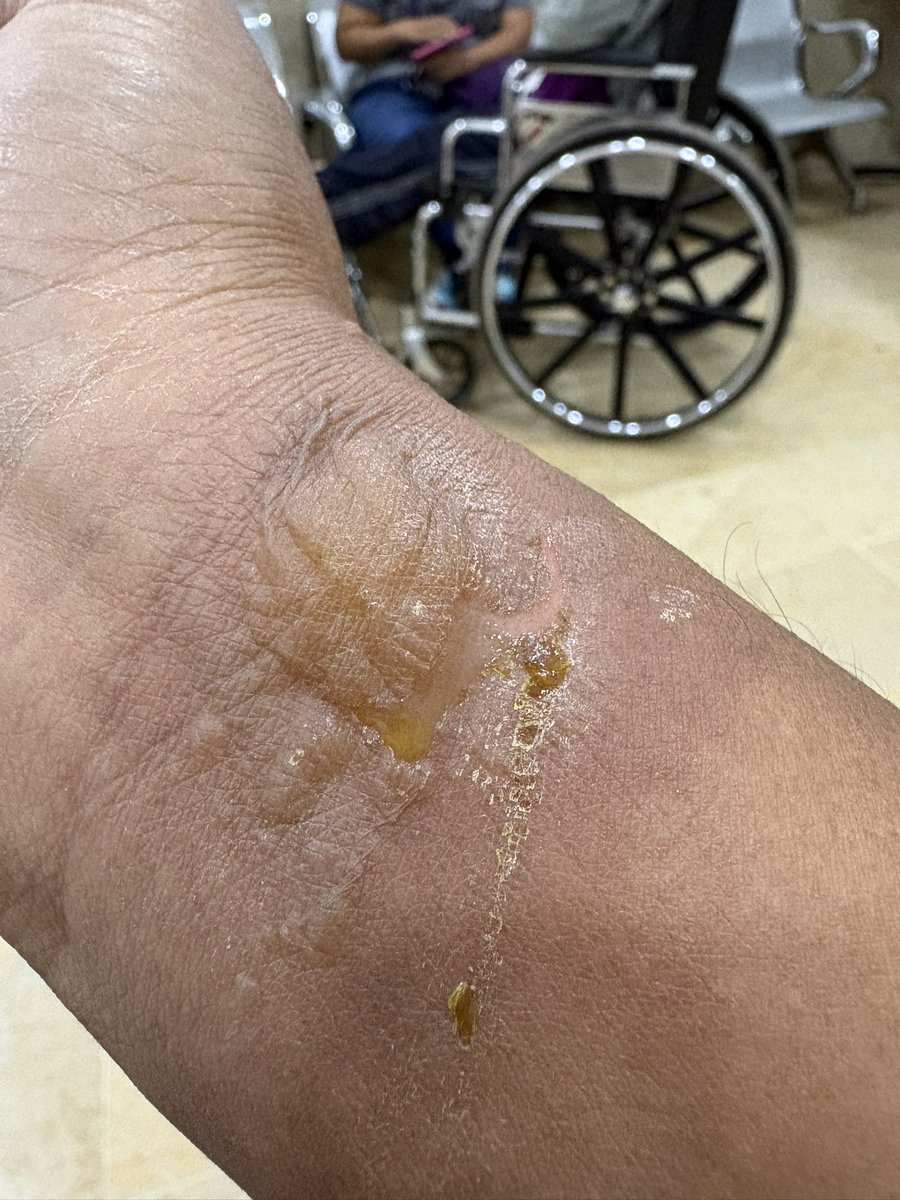 pipestla's tweet photo. @ISSSTEP_Puebla Cuando vienes a urgencias por una quemada, y solo te ponen una venda porque no tienen material de curación para tratar la herida. Te recetan medicamento para el dolor y antibiótico y tampoco hay, que te aguantes hasta el lunes para que te lo den en tu clínica! 👍 https://t.co/jkyweNAULh