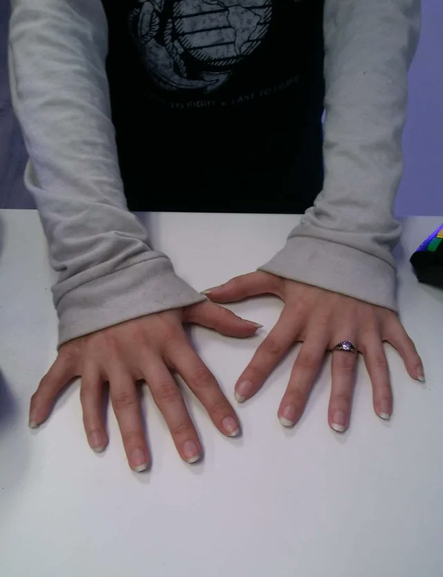 JinnRemona's tweet photo. @SlimeNotSoShady @PicturesFoIder What are you smoking that makes you this stupid? Seems like some primo shit. Also, six fingers per hand is a real disorder, you dense motherfucker. Not everything is AI just because you don’t understand it. https://t.co/2xXkJigpCO