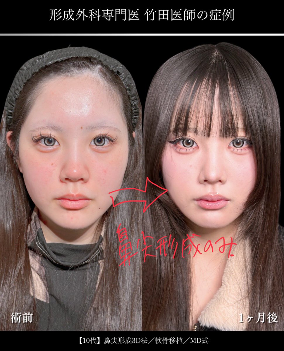 dr_shohei's tweet photo. 鼻尖形成のみの症例で術後1ケ月
やりすぎずナチュラルな仕上がり
一番大切なことは顔全体のバランスを考えて、鼻の存在感を調整すること
#鼻尖形成 #jsaps #形成外科専門医 https://t.co/Zt4ebbvGZz