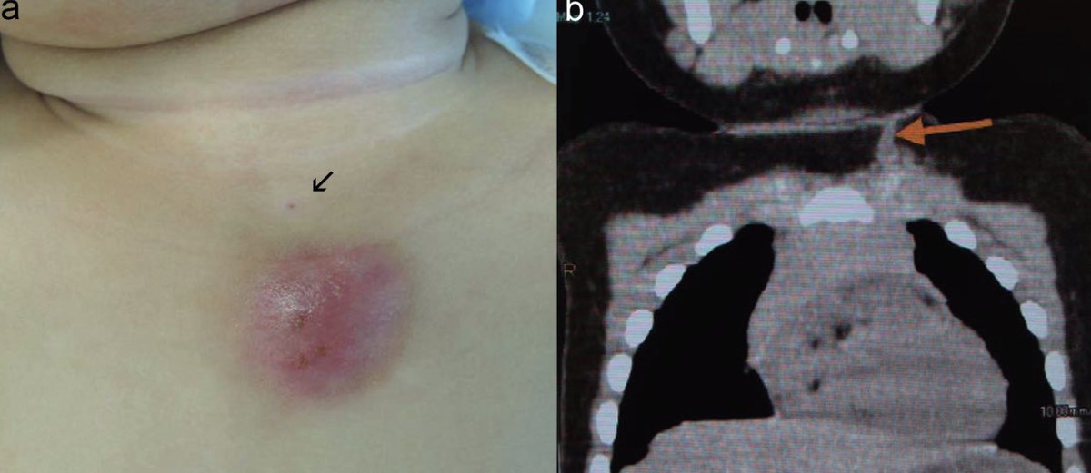 Norimoto_pr's tweet photo. congenital dermoid fistula of the anterior chest region
☑️左胸鎖関節の皮膚小孔+下方深部へ伸びる嚢胞、瘻孔
☑️側頚嚢胞+瘻孔:皮膚〜上方深部へ伸びるので逆
☑️嚢胞+瘻孔も切除しないと再発リスク→dermoidとエコー形態で鑑別意義あり
画像報告少だが多分そこ��で稀でない

PMID 18779909 #Rdiag https://t.co/OcBhuIBl7H