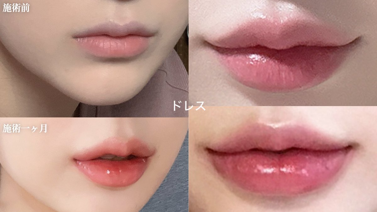 2024_0406's tweet photo. 🇰🇷ロシアンリップ上手なクリニック6選💋
ぷっくりセクシー唇作ってるところ🏥

✅チャミン
ロシアンリップ韓国イチ上手い。私評価ね
針の入れ方、注入方法が違いすぎる。プロ。

✅オリンゴンジュ
ロシアンとかセクシー唇上手で現地人気高いけど、日本マーケしてなくて不便
通訳者雇って同行必須。日本マーケお願いします

✅ダシオン
前にフィラーのPR依頼もらって情報収集したらロシアンめちゃ上手いし施術も高評価だった
次ロシアンやるなら多分ここ試す

✅ロリポップ
コスパ重視の人はここ！安い上手い！！
ロシアンとは少し違うかもだけど

✅ドレス
フィラー全般人気。額も綺麗！常に韓国人��ンニで混み合ってる。日本人料金なくてコスパ良かった、今はどうかわかんない

✅モンスター
輪郭くっきりのボリューミーリップ上手いらしい
フォロワーさん教えてくれて気になってる！

💋チャミンはロシアンリップ成功率◎
実際受けた時のレポツリーに貼っておきます🙇‍♀️⬇️
