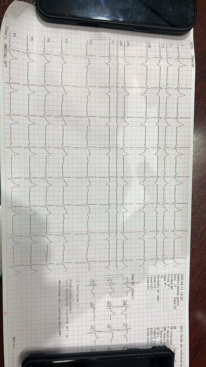 Si tienes 23 años, mujer… y te mareas…. Y estás menstruando… pero tomas bebidas energetizantes y fentermina que pensarías con este EKG?