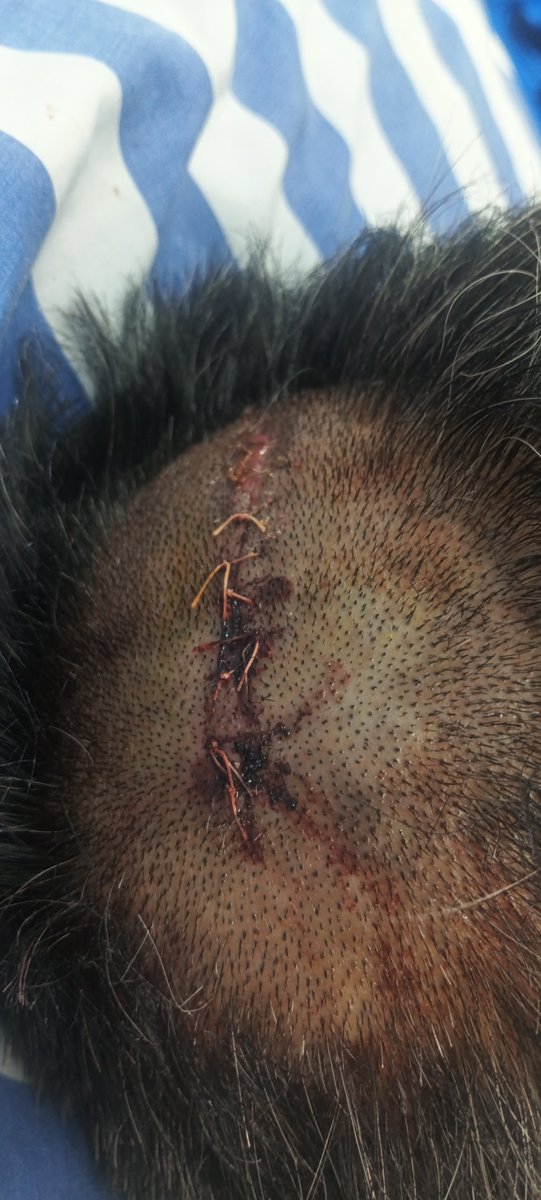 RandomBits16's tweet image. Booked an Uber auto that met with an accident due to driver overspeeding. Vehicle toppled, causing a head injury (stitches) and ₹22k medical expense.
Despite sharing all docs, I’m told no insurance applies. @Uber_India take responsibility&amp;amp; assist.
#UberIndia #CustomerSafety