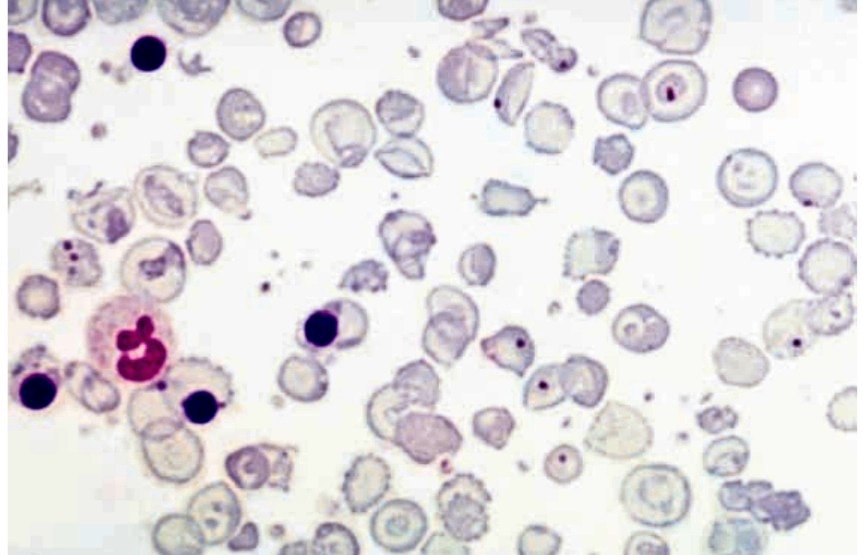 AliAl_khalifah's tweet photo. سؤال طبي ⁉️

What is the most likely diagnosis or underlying condition ?
ما هو التشخيص الأكثر ترجيحاً أو الحالة المرضية الكامنة؟
#مختبرات
#مختبرات_طبية 
#تحليل 
#AliAl_khalifah #diagnostic #case_study https://t.co/baujoN3fgK