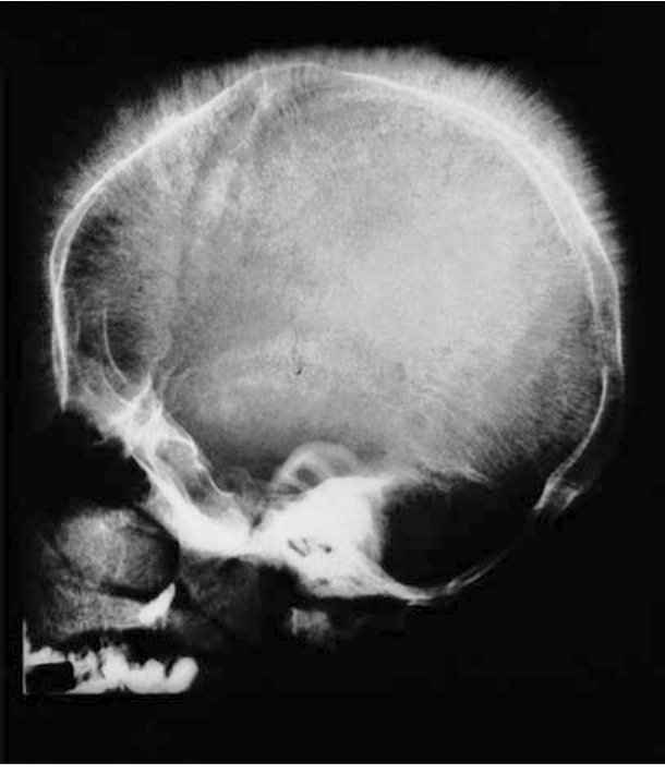 AliAl_khalifah's tweet photo. سؤال طبي ⁉️

What is the most likely diagnosis or underlying condition ?
ما هو التشخيص الأكثر ترجيحاً أو الحالة المرضية الكامنة؟
#مختبرات
#مختبرات_طبية 
#تحليل 
#AliAl_khalifah #diagnostic #case_study https://t.co/baujoN3fgK
