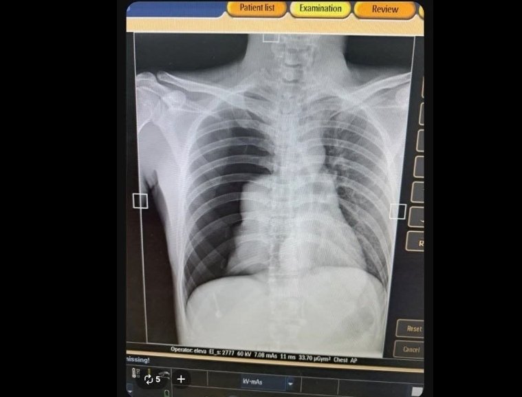 badidoyo's tweet photo. Saya iseng meminta Grok untuk memberikan diagnosa dari foto rontgen yg sudah saya crop(gambar kiri) ini dengan perintah:

"Berikan diagnosis dari foto thorax ini. Pasien usia 29 tahun, merokok sudah 13 tahun. Datang ke IGD dengan keluhan sakit dan sesak" 

@grok semakin hari semakin canggih!

Kalian bisa bandingkan sengan diagnosa dari dr. Gia dan dr. Tirta (gambar kanan), apakah ada perbedaan? 

Berikut  hasil diagnosa oleh Grok:

**Diagnosis:** Pneumothorax spontan primer (PSP) pada paru kanan.

**Penjelasan singkat berdasarkan foto thorax Chest AP yang diberikan:**

Foto menunjukkan **tanda klasik pneumothorax** di sisi kanan (pasien’s right — sesuai label “R” di kanan gambar):
- Ada **garis pleural visceral** yang tipis dan tegas (visceral pleural line).
- Di luar garis tersebut (perifer lateral kanan) terlihat area **hiperlusen** (sangat hitam) tanpa pola vaskular paru maupun markings paru.
- Paru kanan tampak kolaps sebagian (lung collapse).

Tidak terlihat infiltrat, efusi pleura, atau pembesaran jantung. Mediastinum masih tengah (belum ada tanda tension pneumothorax).

**Kesesuaian dengan klinis pasien:**
- Usia 29 tahun + merokok 13 tahun → risiko tinggi PSP (ruptur bleb/bulla subpleural).
- Keluhan mendadak **sakit dada + sesak napas** di IGD → sangat khas untuk pneumothorax spontan.
- Tidak ada riwayat trauma (bukan sekunder).

**Rekomendasi penanganan segera (di IGD):**
- Oksigen suplementasi tinggi.
- Observasi saturasi & tanda vital.
- Jika pneumothorax > 2 cm atau ada gejala sesak berat → **chest tube** (intercostal drain).
- Konfirmasi dengan dokter radiologi/pulmonologi untuk ukuran & keputusan selanjutnya.

Foto thorax ini **bukan normal** dan langsung menjelaskan keluhan pasien. Segera tindak lanjut sesuai protokol IGD.