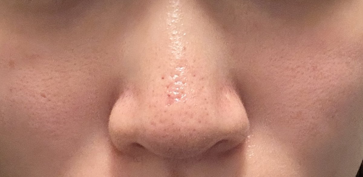 chachacha_hah's tweet photo. ジュベルック手打ち5回目2週間後
今の鼻の毛穴は感じです👃
素晴らしすぎる😭😭😭 https://t.co/wZBUFfvL9i