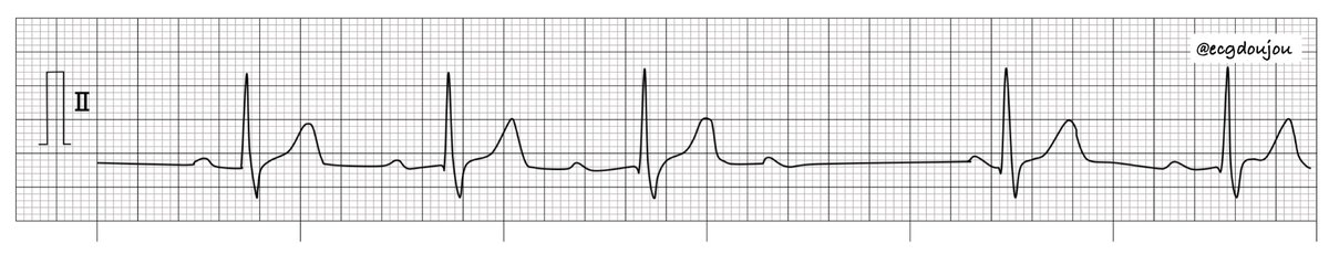 ecgdoujou's tweet image. こんばんは👍心電図道場です‼️  
今日も1問心電図です💪
リズムを読んで答えてください🎵