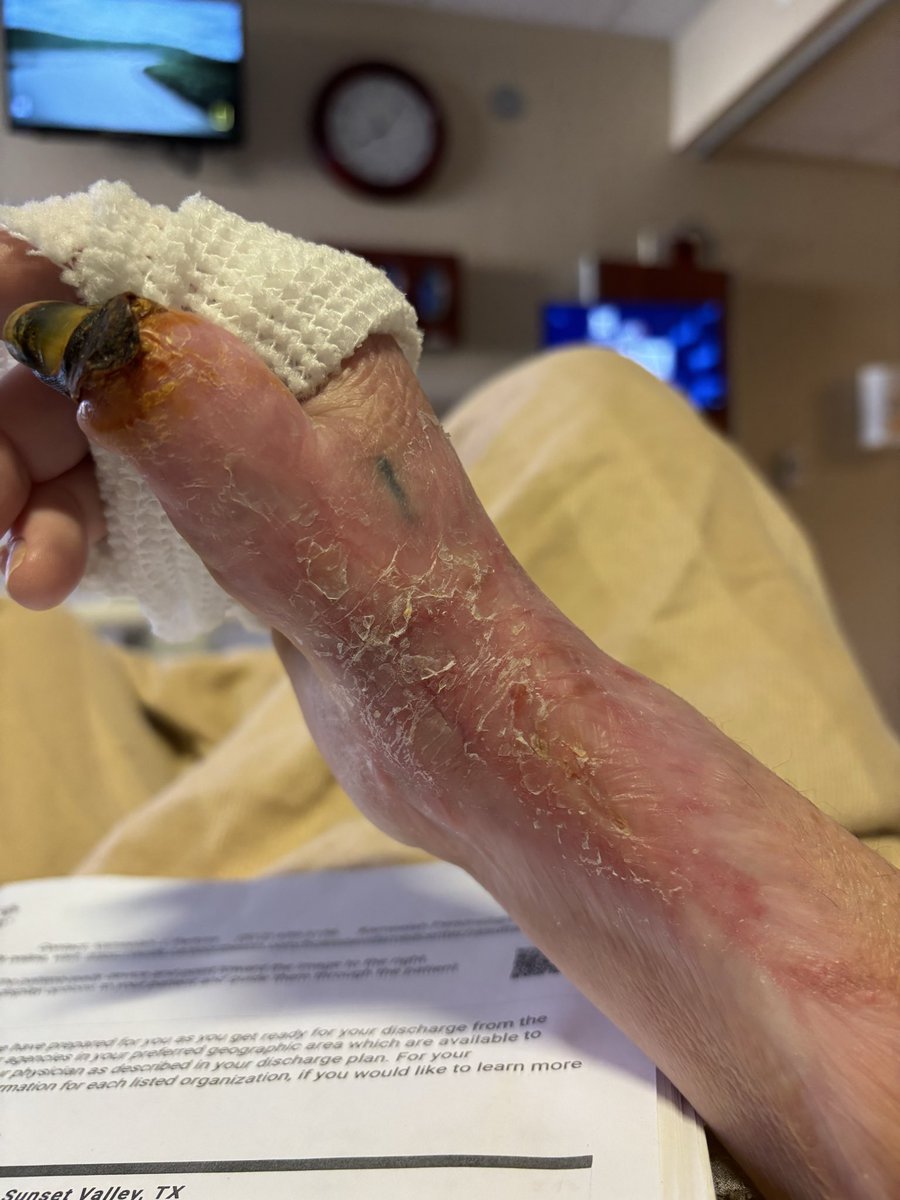 NotMeUsGenX's tweet photo. My arm currently, what a miracle! I’ll post the before and then the pics I took yesterday… I’m unable to worry right now and have some bills due this week. Please please help if you can. Please. https://t.co/z5dem7b1s5  or my Venmo is Katrina_Primeau  both are in my bio. Thank you!