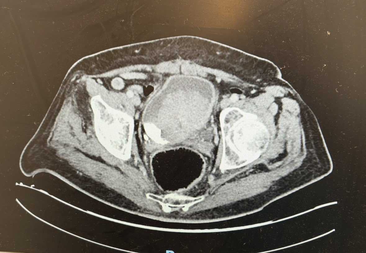 Dmitry_Enikeev's tweet image. Giant bladder tumor managed laser en bloc, followed by morcellation and stent placement.
Final pathology: T1HG.
Specimen quality preserved.
Accurate #staging remains achievable.