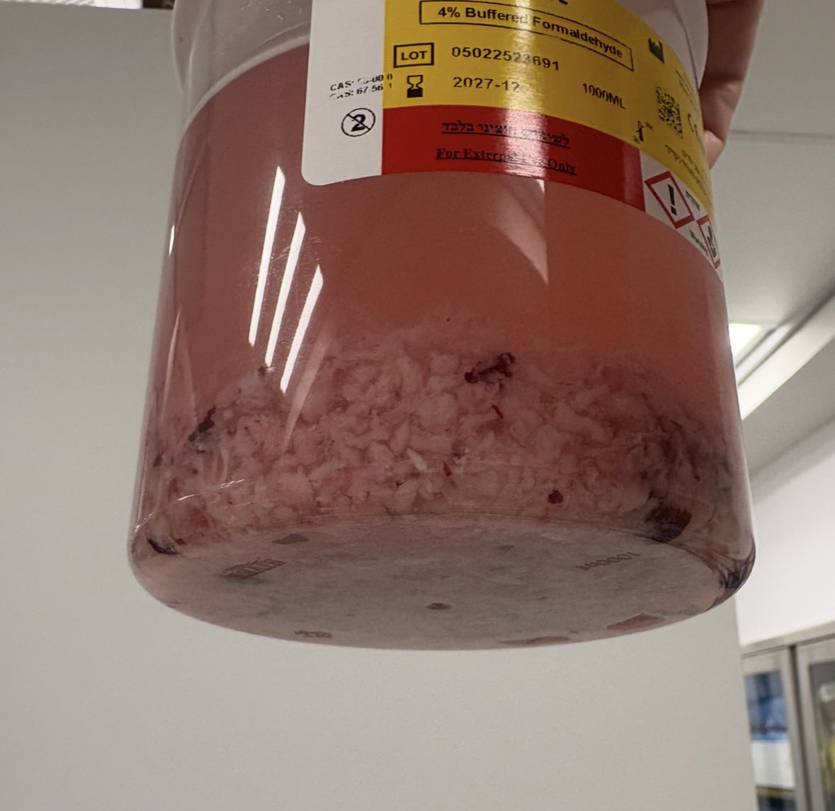 Dmitry_Enikeev's tweet image. Giant bladder tumor managed laser en bloc, followed by morcellation and stent placement.
Final pathology: T1HG.
Specimen quality preserved.
Accurate #staging remains achievable.