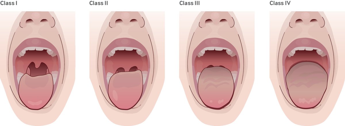 bmj_latest's tweet image. Airway management is an important skill for clinicians who care for adults who are acutely ill. 

This review summarises the current data and provides an evidence based approach to airway management #MedEd
bmj.com/content/393/bm…