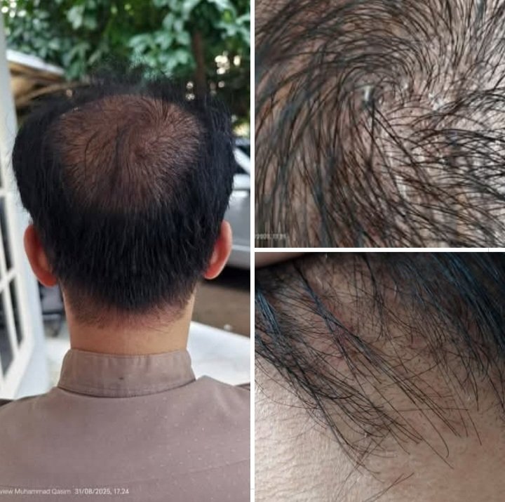 Hair strands are sprouting from Muhammad Qasim’s head, even in areas long considered permanently bald. Muhammad Qasim