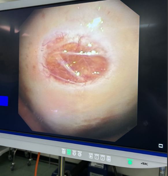 YCGaryLee's tweet photo. #PLEURAL_PEARLS_WA 38
Thoracoscopic view of the 'hole' a chest tube made at the parietal pleura. All pleural interventions are invasive with risks: pain; bleed; organ puncture. Benefits need to justify risks.

@tsanz_thoracic @AAB_IP @accpchest @ALATorax @SMNYCT @PleuralPOCUS @iPulmOG @PulmPEEPs @tony_breu @PulmCrit @sfaiz212
