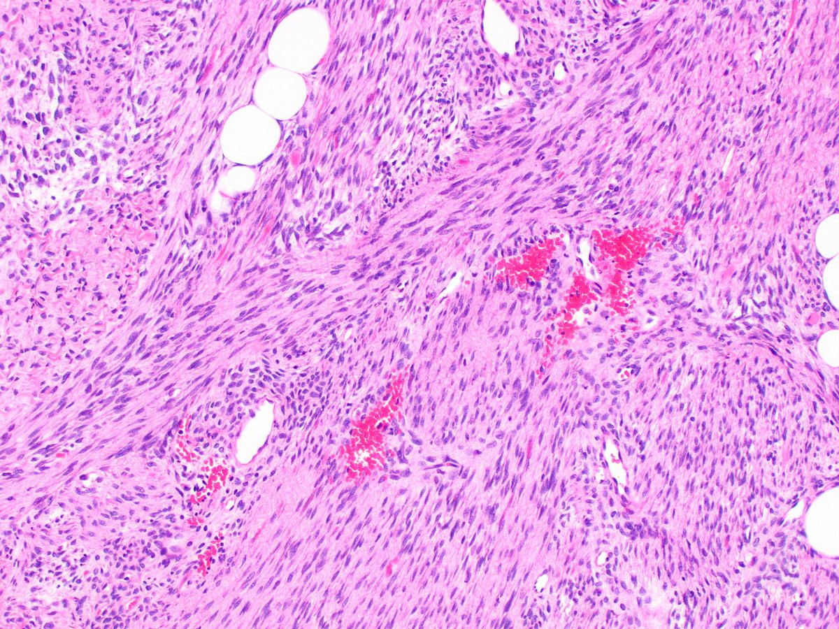 DrCycloPath's tweet image. #PathQuiz 🔬

A) Lipoblastoma
B) Myofibroma
C) Low-grade myofibroblastic sarcoma
D) Infantile Fibrosarcoma

#Pathology #PediPath #SoftTissuePath