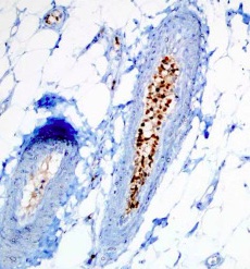 d_e_n_i__z's tweet image. A case report and literature review of cutaneous intravascular large B... sciencedirect.com/science/articl… 
 #pathology #hemepath #Hematopathology #dermatopathology #dermpath #PathologyTweet @levcan
