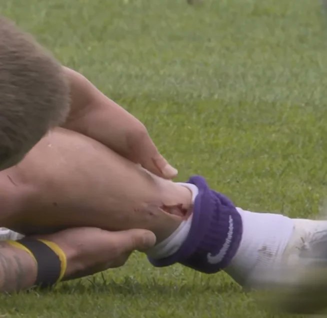 ⚠️ 𝗪𝗔𝗥𝗡𝗜𝗡𝗚: Lewis Holtby suffered a gruesome gash to the leg whilst playing for Dutch side NAC Breda today.