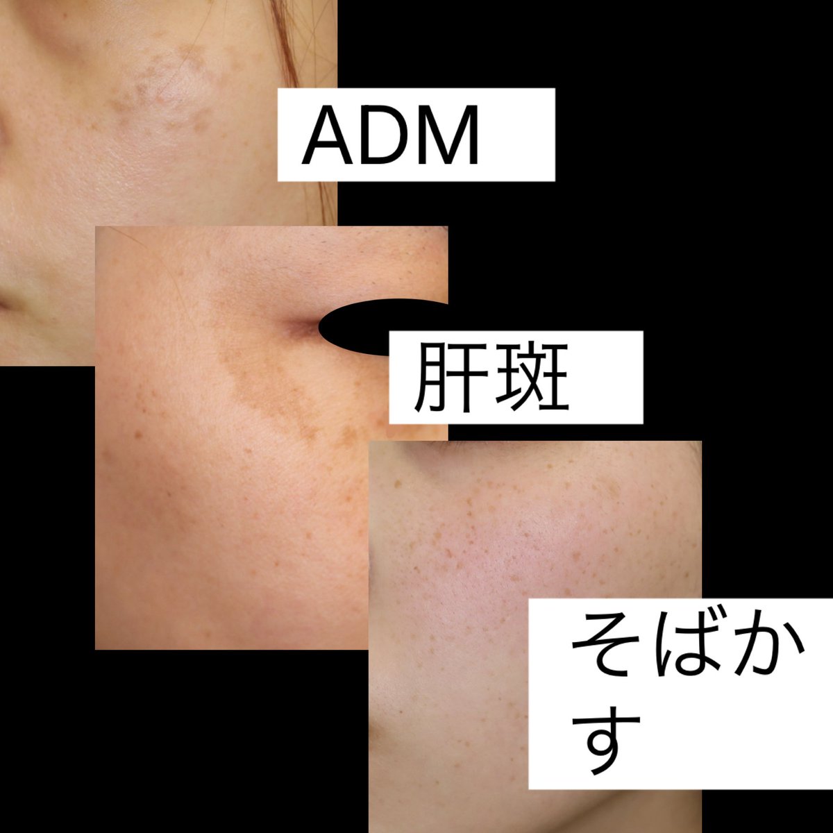 咲くらクリニック総院長小林直隆@シミ肝斑ニキビ酒さを治しています tweet media