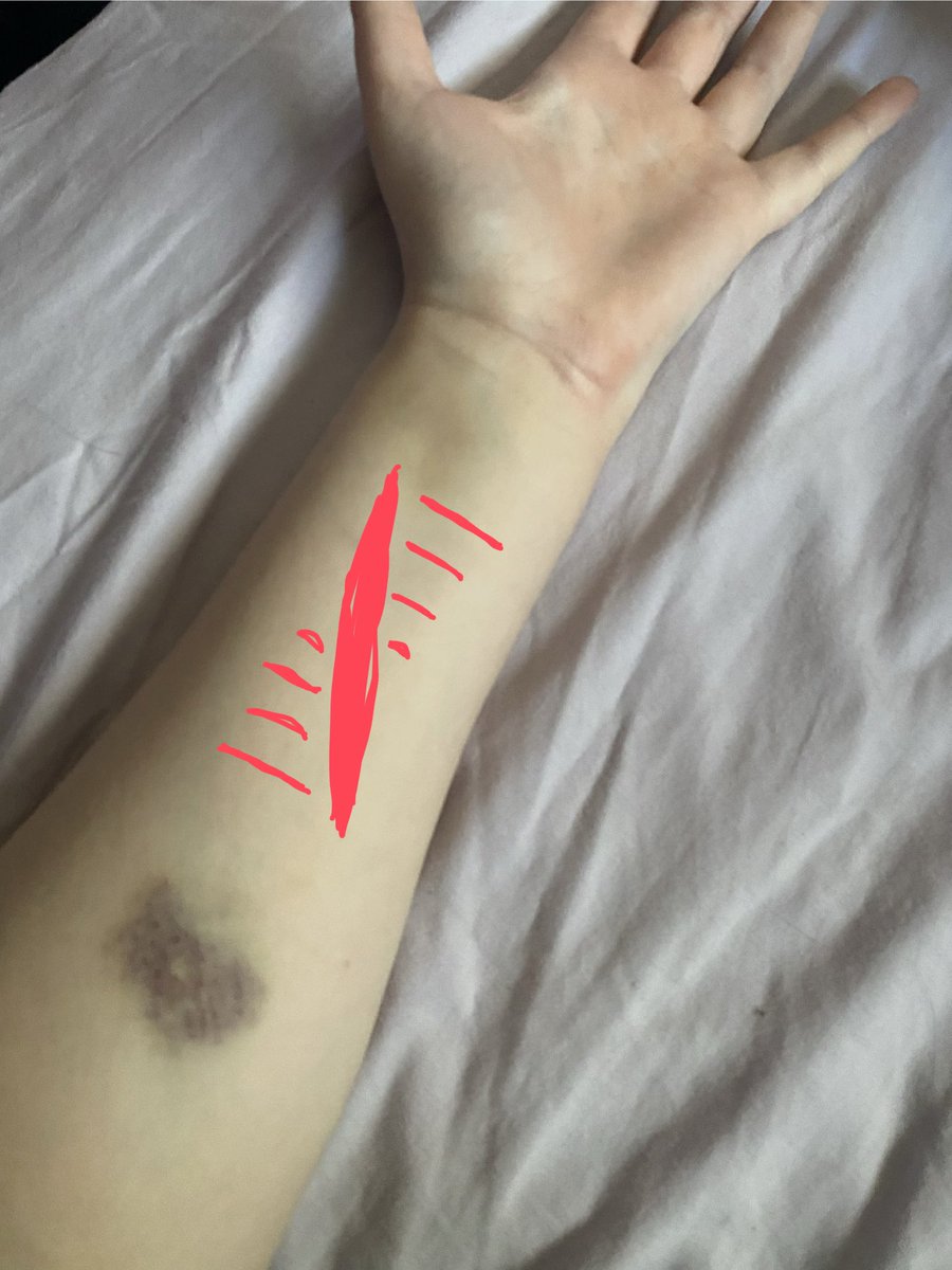 spncerfml's tweet image. ignore the bruising
would smth like this look cool or dumb asf pls help #suicidetwt #shtwt #slittwt