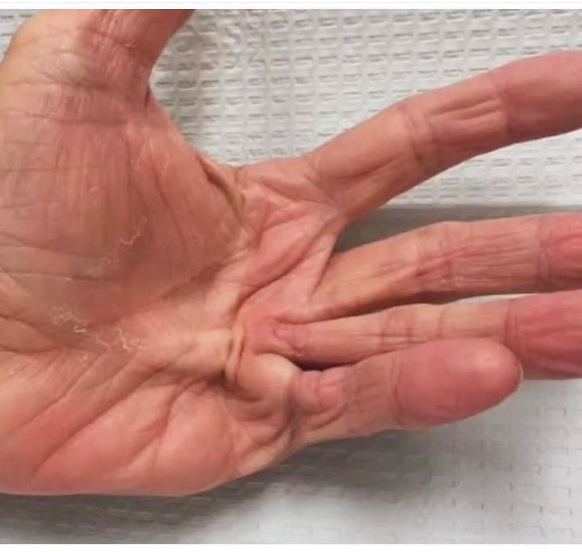 DrMedica_13's tweet image. What is name of this +ve finding &amp;amp; Diagnosis?

🥀☘️🥀