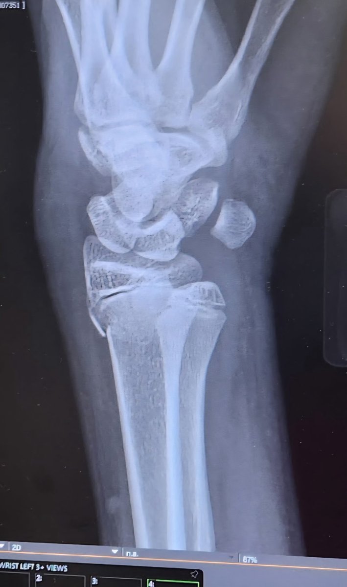 Nate_potter's tweet photo. Played 3 1/2 games today, caught 1 touchdown with meca_7v7 757 in Williamsburg and In the process fractured my ulna and radial bone. God works in mysterious ways, but I trust it. Road to recovery starts now. #atag https://t.co/ThALY7A6JP